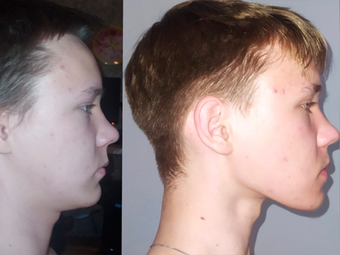 Hard mewing results in before and after transformation pictures